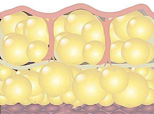 脂肪液化是什么意思