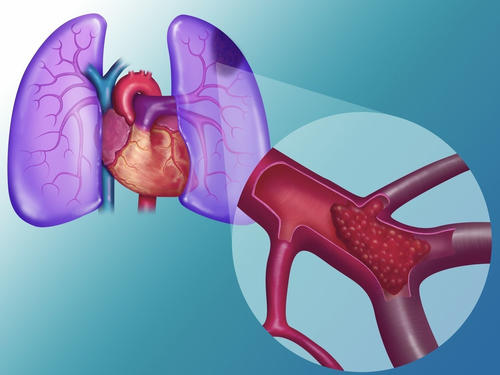 肺栓塞大概有几类