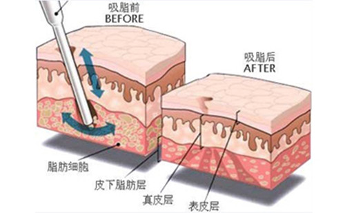 抽脂肪是什么手术