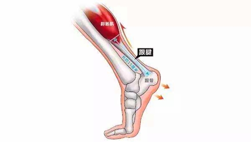 跟腱断裂的症状