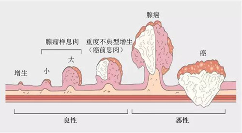 息肉是什么东西