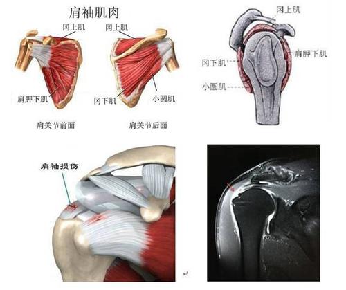 冻结肩是什么原因引起的