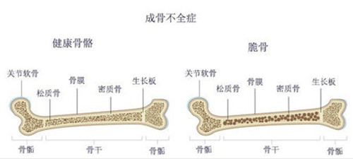 瓷娃娃病是怎么回事