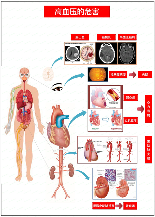 高血压会引起哪些疾病